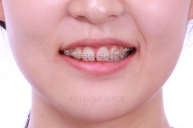 부산클리피씨교정