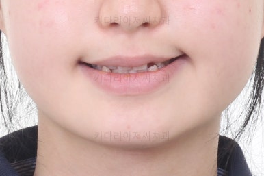 동래구치아교정