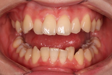 부산돌출입교정