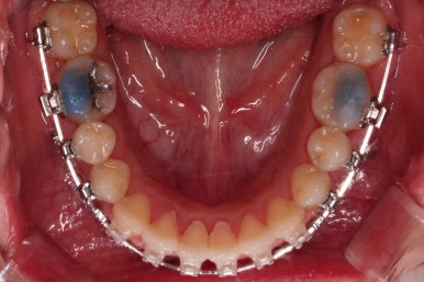 부산비발치교정