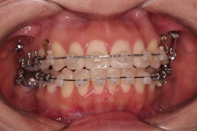 부산사랑니교정