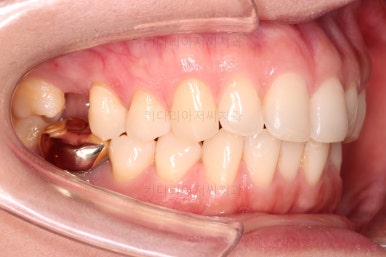 부산치아교정비용