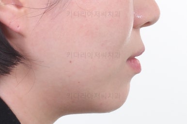 부산치아교정잘하는곳