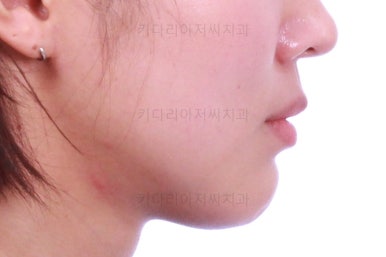 부산치아교정잘하는곳