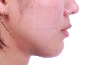 부산치아교정잘하는곳 키다리아저씨치과에서 시행한 미세돌출과 뻐드러진 앞니를 재교정한 치료사례