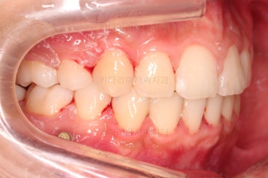 부산클리피씨교정