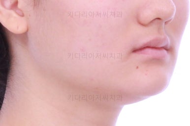 연산동치아교정