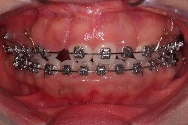 부산구순구개열