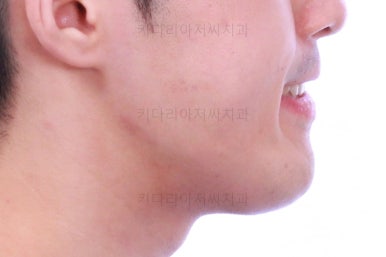 부산긴얼굴긴턱교정