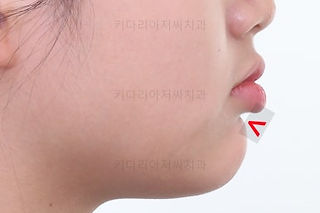연산동치아교정
