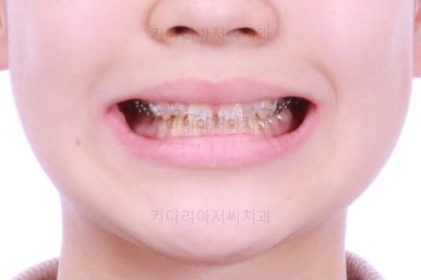 부산연산동치아교정
