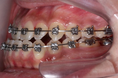 부산주걱턱교정