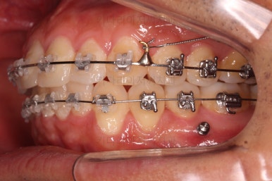 부산교정치과추천