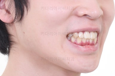 부산돌출입교정