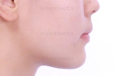 부산연산동치아교정