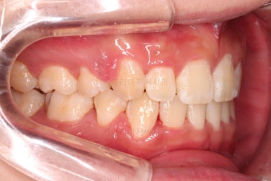 부산돌출입교정