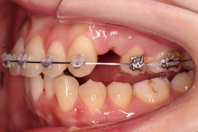 부산돌출입교정
