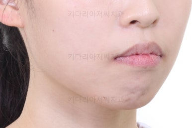 부산클리피씨교정