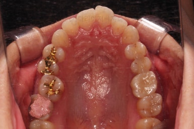 부산사랑니교정