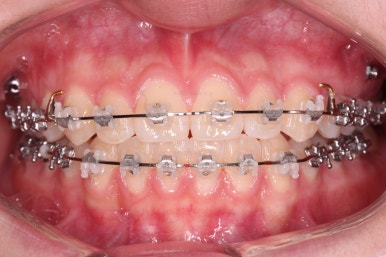 부산치아교정잘하는곳