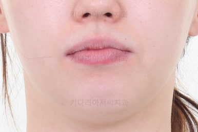 부산비대칭교정