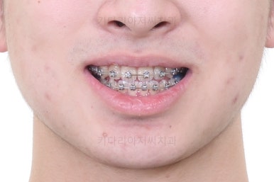 부산교정치과추천