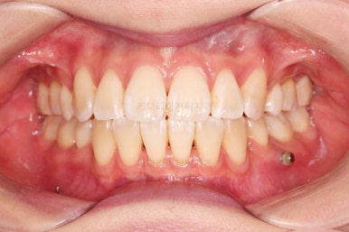 부산치아교정잘하는치과