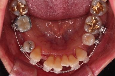 동래임플란트교정