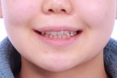 부산앞니벌어짐교정
