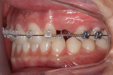 부산매복치아교정