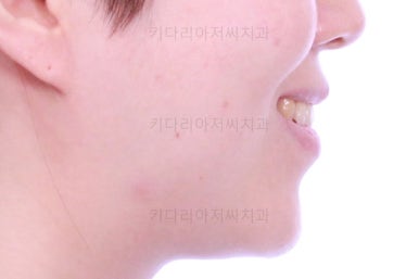 부산치아교정잘하는곳