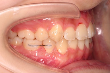 동래구치아교정