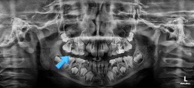 부산어린이치아교정