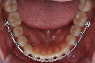 부산치아교정잘하는곳