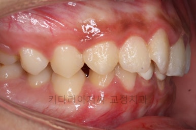 연산동치아교정