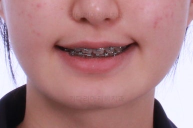 동래구치아교정