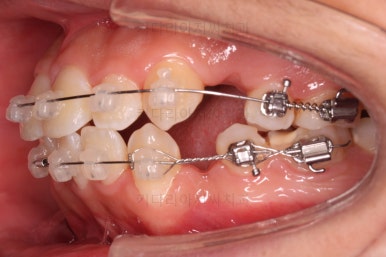 부산청소년치아교정