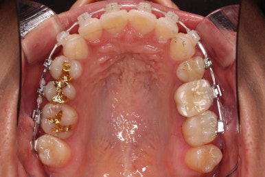 부산사랑니교정