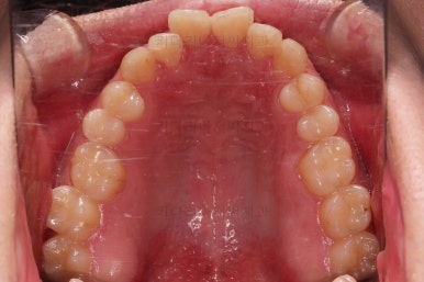 부산긴얼굴긴턱교정