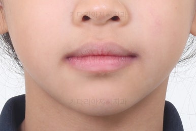 부산어린이반대교합