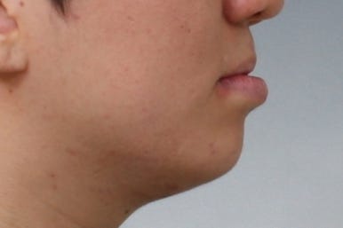 부산구순구개열