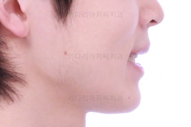 부산돌출입교정