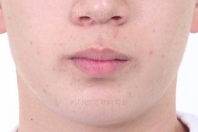 부산청소년치아교정