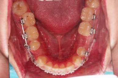 부산주걱턱교정