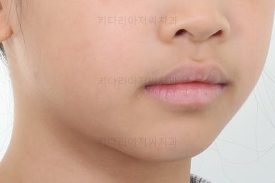 부산어린이반대교합