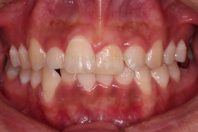 부산안면비대칭