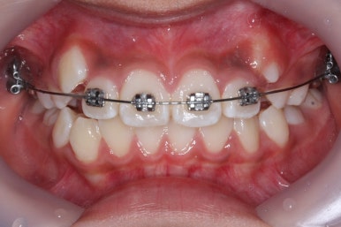 연산동덧니교정