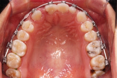 부산구순구개열