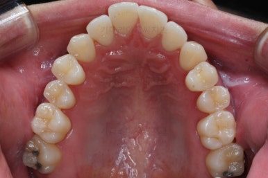 부산비수술교정