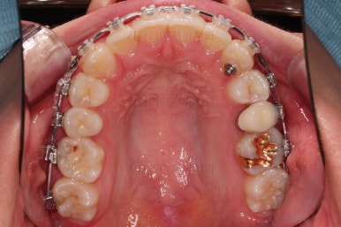 부산비대칭교정